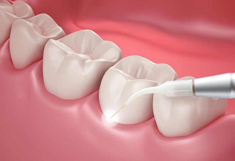 Gums Treatment