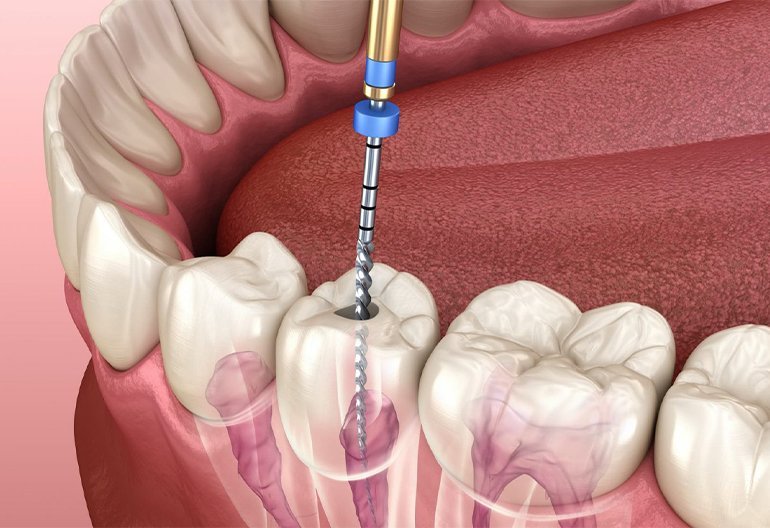 Root Canals