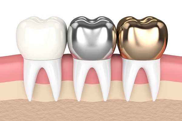 Dental Crown