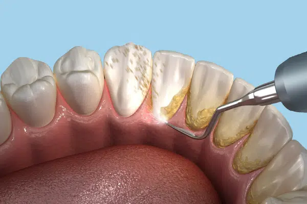 Teeth Scaling